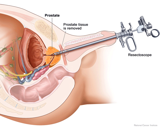 Prostat İltihabı